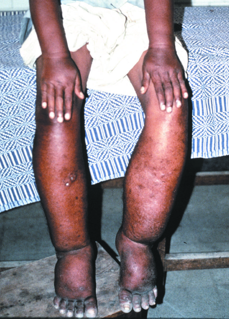 Elephantiasis due to infection with Wuchereria bancrofti.
