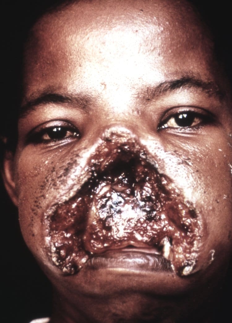 Espundia - severe mucocutaneous leishmaniasis.