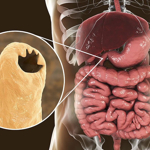 Parasitic hookworm Ancylosoma duodenale in human duodenum