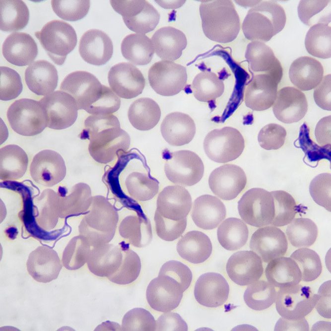 Trypanosoma gambiense blood smear